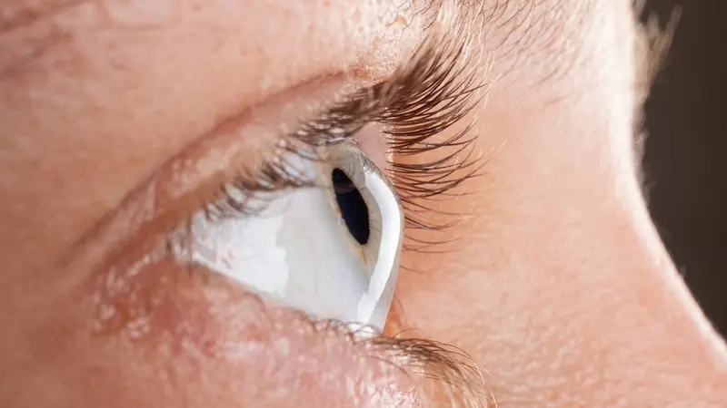 Keratokonusta Sık Sorulan Sorular